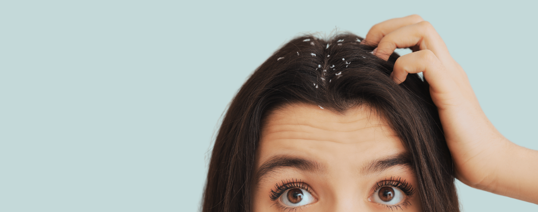 How to Get Rid of Dandruff, and Keep It Gone This Winter