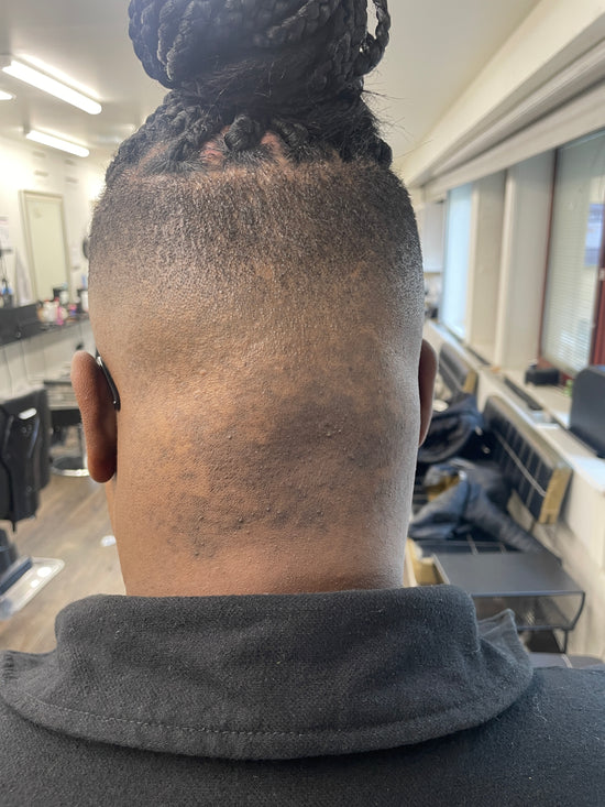 Client F. 4 months  later