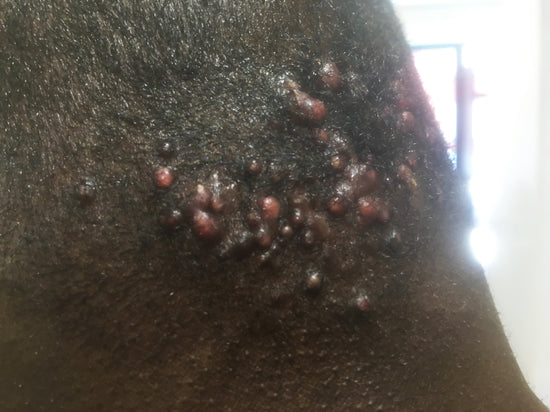 Klient F. Acne Keloidalis Nuchae