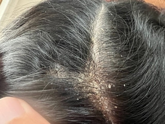 Klient B. Psoriasis